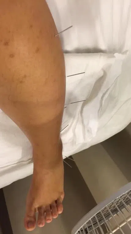 张媛婷一开始找中医治疗，但没有起色，去医院急诊才发现左腿深静脉血栓阻塞。（受访者提供）