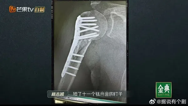 林志颖公开X光片。（取自微博）