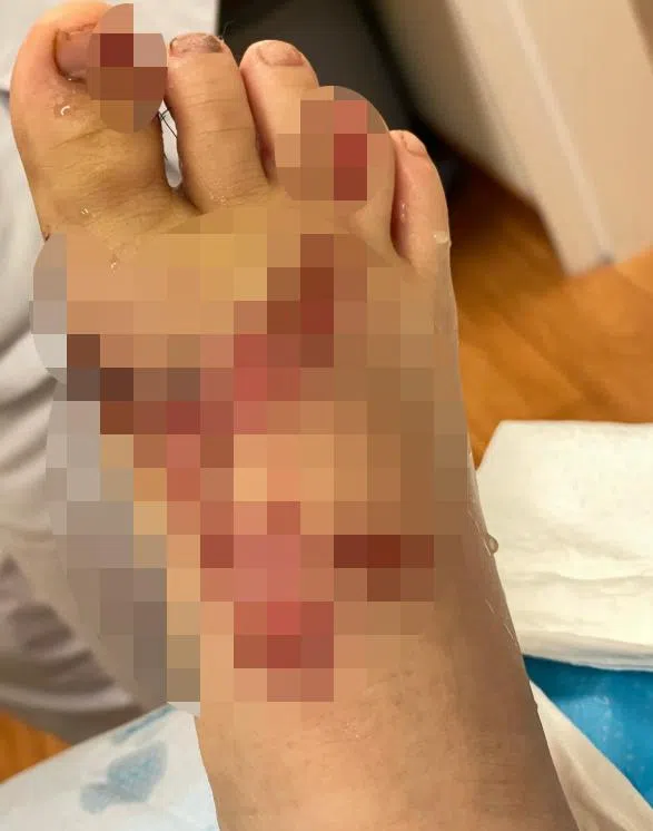 男童右脚背和脚趾撕裂，动手术缝了好几针。（受访者提供）