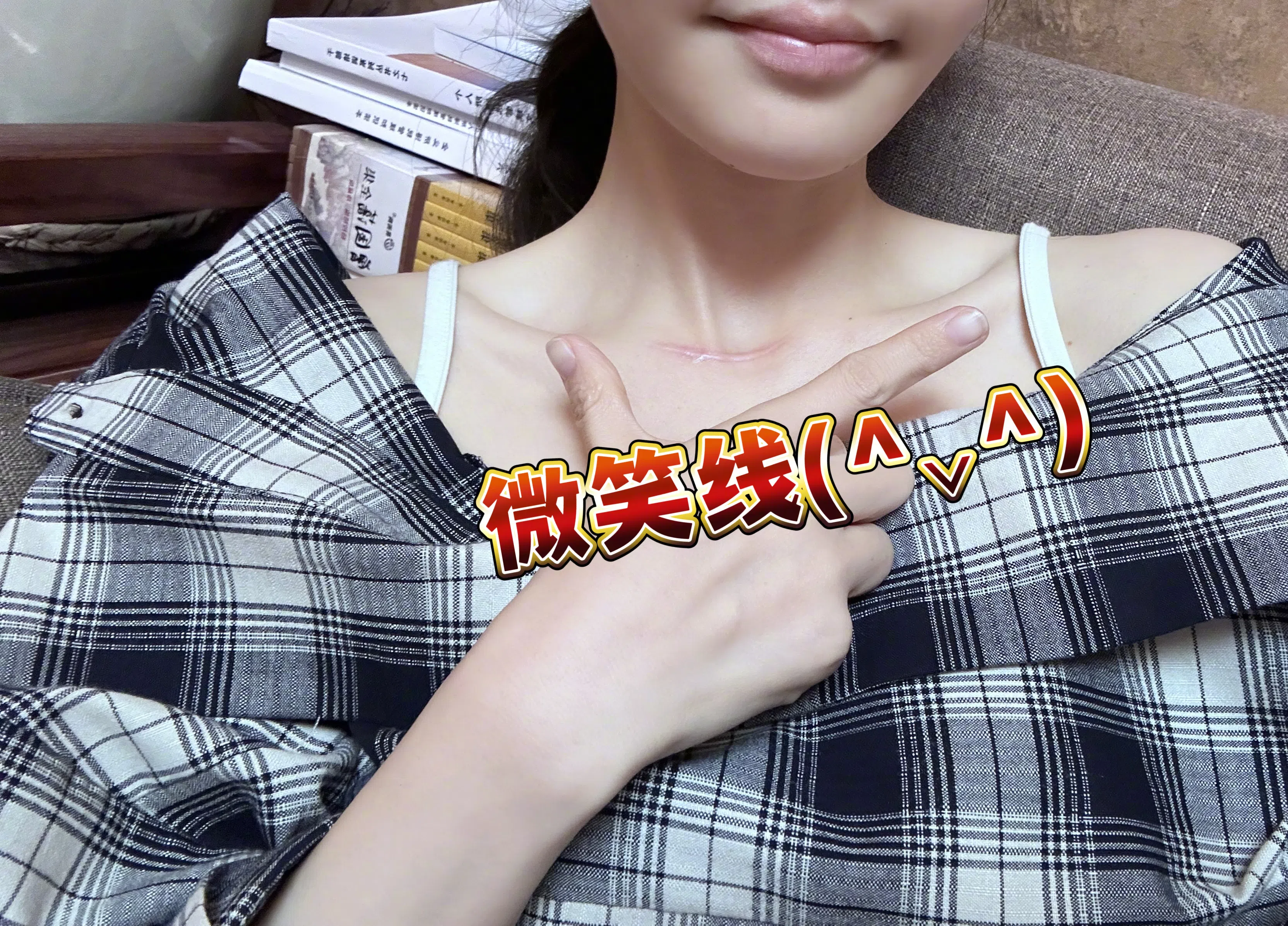 冯提莫术后在脖子上留下一条“微笑线”疤痕。（取自冯提莫微博）
