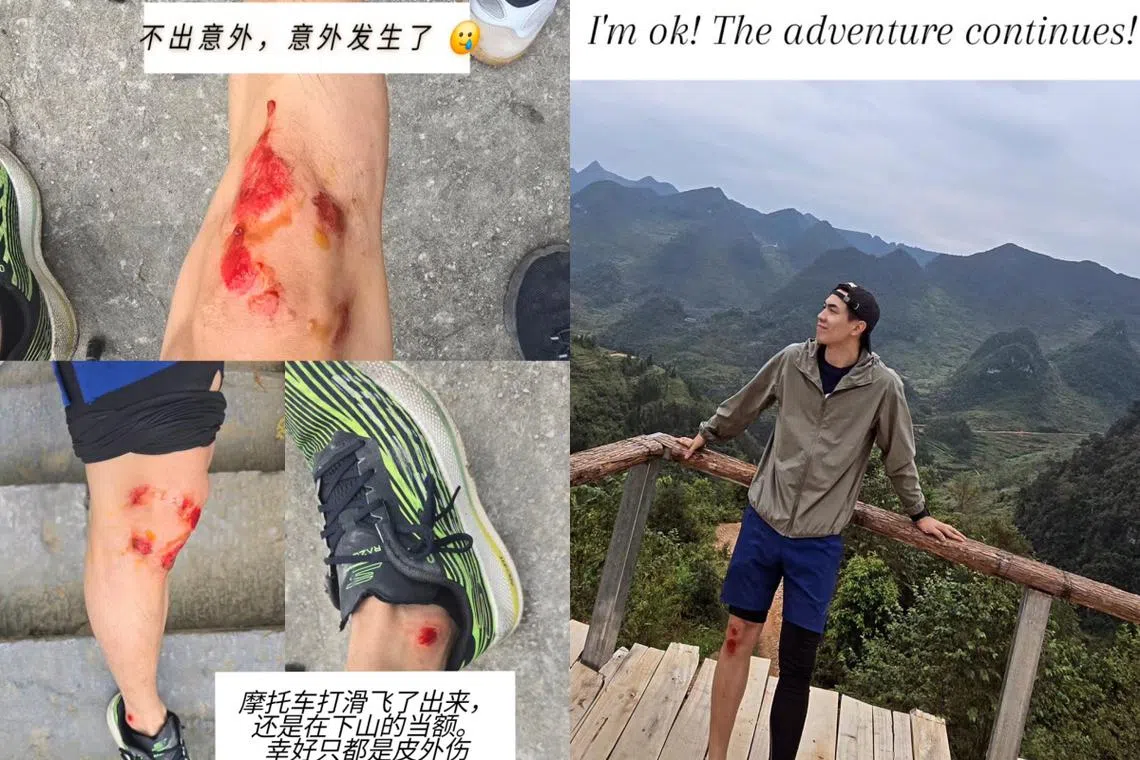 张奕恺发生意外受伤，庆幸只是皮外伤。（取自张奕恺IG）