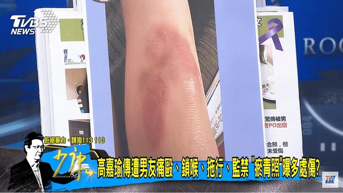 TVBS政论节目《少康战情室》曝光的一张高嘉瑜腿部伤势照。（TVBS《少康战情室》截图）